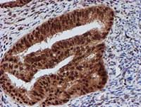 ab128534, at 1/150 dilution, staining CRYZL1 in paraffin-embedded Human endometrium adenocarcinoma tissue by Immunohistochemistry.