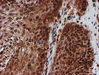ab128534, at 1/150 dilution, staining CRYZL1 in paraffin-embedded Human bladder carcinoma tissue by Immunohistochemistry.