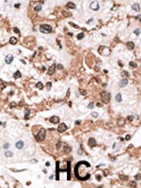 Ab59936 (1/50-1/100) staining human CSEN in human cancer tissue by immunohistochemistry using formalin fixed, paraffin embedded tissue. Formalin-fixed and paraffin-embedded human cancer tissue reacted with the primary antibody, which was peroxidase-conjugated to the secondary antibody, followed by AEC staining. HC = hepatocarcinoma.