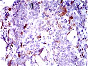 Immunohistochemical analysis of paraffin-embedded breast cancer tissues labeling GPNMB wiith ab175427 at 1/200 diution, with DAB staining.