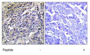 Immunohistochemistry analysis of paraffin-embedded human lung carcinoma tissue using ab69884 at 1/50 dilution in the presence or absence of the immunising peptide.