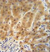 Immunohistochemical analysis of formalin fixed, paraffin embedded Human hepatocarcinoma tissue labeling GRHPR with ab176011 at a 1/50 dilution, followed by peroxidase conjugation of the secondary antibody and DAB staining.