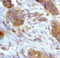 Immunohistochemical analysis of paraffin-embedded human breast carcinoma using ab32558 at a dilution of 1/100 - 1/250