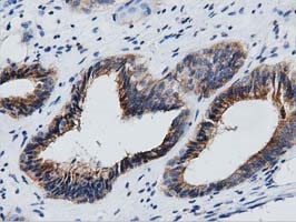 ab123965, at 1/50 dilution, staining Growth Arrest Specific Protein 7 in paraffin-embedded Human endometrium adenocarcinoma tissue by Immunohistochemistry.
