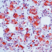 anti Human Growth Hormone (form of ab81203 containing BSA and Azide), at a dilution of 1/1000, staining Human Growth Hormone in formalin fixed paraffin embedded human pituitary tissue sections by Immunohistochemistry. Peroxidase conjugate and AEC chromogen were used. Note cytoplasmic staining of anterior pituitary cells.