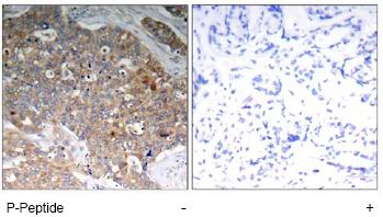 ab75745, at a 1/50 dilution, staining GSK3 beta in paraffin embedded human breast carcinoma tissue by Immunohistochemistry, in the absence (left image) or presence (right image) of the immunizing phospho peptide.