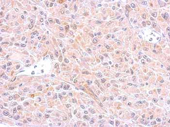 Immunohistochemical analysis of paraffin-embedded U87 xenograft, labeling GST3 / GST pi with ab153949 at 1/500 dilution.