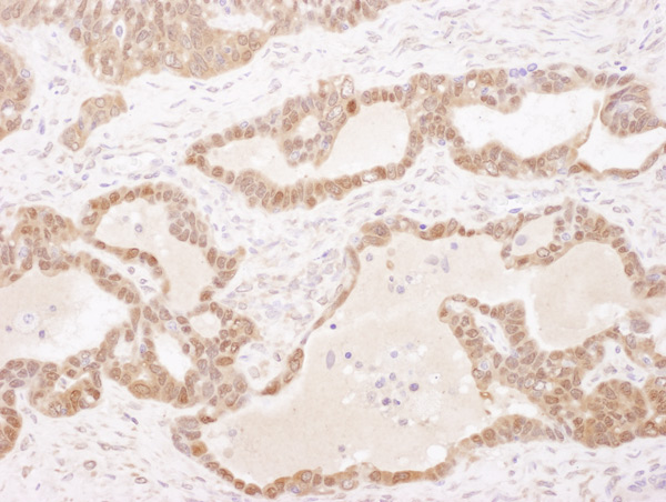 Immunohistochemistry (Formalin/PFA-fixed paraffin-embedded sections) analysis of human ovarian carcinoma tissue labelling GST3 / GST pi with ab129456 at 1/5000 (0.2µg/ml). Detection: DAB.