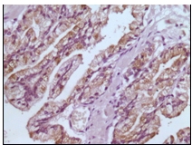 Immunohistochemical analysis of paraffin-embedded normal human prostate tissue, showing cytoplasmic/ nuclear localization , using ab47709 at a 1/500 dilution, with DAB staining.