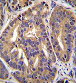 Immunohistochemical analysis of formalin-fixed, paraffin-embedded Human prostate carcinoma tissue labeling GTF2H2 with ab170429 at 1/10 dilution, followed by peroxidase conjugation of the secondary antibody and DAB staining.