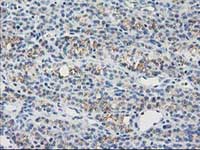 ab119063, at 1/150 dilution, staining Guanylate kinase in paraffin-embedded Human thyroid carcinoma tissue by Immunohistochemistry.