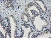 ab119063, at 1/150 dilution, staining Guanylate kinase in paraffin-embedded Human prostate carcinoma tissue by Immunohistochemistry.