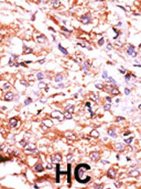 Ab60200 (1/50 dilution) staining GUCY1A2 in formalin fixed, paraffin embedded human hepatocarcinoma tissue by immunohistochemistry. The primary antibody was peroxidase-conjugated to the secondary antibody, followed by AEC staining. HC = hepatocarcinoma.