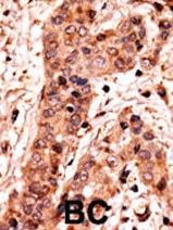 Ab60226 (1:50) staining human Guanylyl Cyclase alpha in human breast carcinoma tissue by immunohistochemistry using formalin fixed, paraffin embedded tissue. Formalin-fixed and paraffin-embedded human cancer tissue reacted with the primary antibody, which was peroxidase-conjugated to the secondary antibody, followed by AEC staining. BC = breast carcinoma