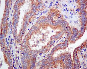 Immunohistochemical analysis of formalin-fixed, paraffin-embedded Human thyroid gland carcinoma tissue, labeling Guanylyl Cyclase beta 1 using ab154841 at a 1/100 dilution.