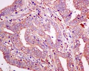 Immunohistochemical analysis of paraffin embedded Human endometrial carcinoma tissue using ab154841 showing +ve staining.