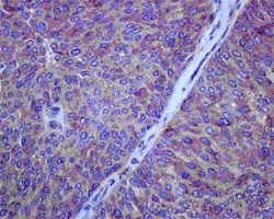 Immunohistochemical analysis of paraffin-embedded Human transitional cell carcinoma of bladder tissue labeling HAPLN1 with ab181997 at 1/50 dilution followed by pre-diluted HRP-conjugated secondary antibody and counter-stained with Hematoxylin.