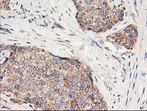 ab123918, at a 1/150 dilution, staining HARS2 in paraffin embedded adenocarcinoma of Human breast tissue by Immunohistochemistry.