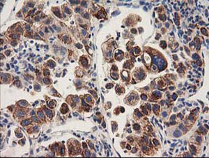 ab123918, at a 1/150 dilution, staining HARS2 in paraffin embedded carcinoma of Human lung tissue by Immunohistochemistry.