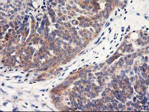 ab123918, at a 1/150 dilution, staining HARS2 in paraffin embedded adenocarcinoma of Human ovary tissue by Immunohistochemistry.