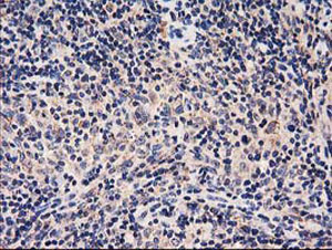 ab123918, at a 1/150 dilution, staining HARS2 in paraffin embedded Human lymphoma tissue by Immunohistochemistry.