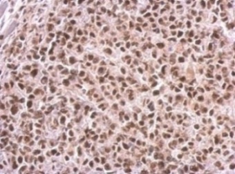 Immunohistochemical analysis of paraffin-embedded HeLa xenograft tissue labeling HAUSP/USP7 with ab183659 at 1/500 dilution.