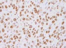 Detection of Mouse HAUSP / USP7 by Immunohistochemistry.Sample: FFPE section of Mouse squamous cell carcinoma.Antibody: ab84098 used at a dilution of 1/100.Detection: DAB.