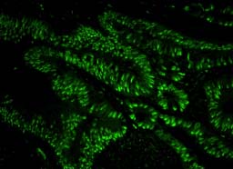 Detection of Human HAUSP / USP7 by Immunofluorescence.Sample: FFPE section of Human colon adenocarcinoma.Antibody: ab84098 used at a dilution of 1/100.Detection: Green-fluorescent Anti rabbit IgG FITC conjugated, used at a dilution of 1/100.