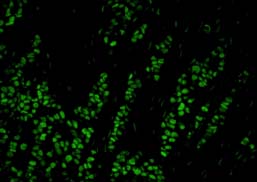 Detection of Human HAUSP / USP7 by Immunofluorescence.Sample: FFPE section of Human breast adenocarcinoma.Antibody: ab84098 used at a dilution of 1/100.Detection: Green-fluorescent Anti rabbit IgG FITC conjugated, used at a dilution of 1/100.