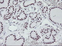 ab119364 at 1/150 dilution staining HAUSP/USP7 in Paraffin-embedded Human thyroid carcinoma tissue by Immunohistochemistry.