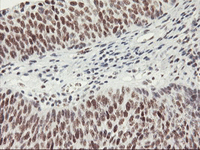 ab119364 at 1/150 dilution staining HAUSP/USP7 in Paraffin-embedded Human bladder carcinoma tissue by Immunohistochemistry.