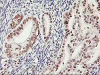 ab119364 at 1/150 dilution staining HAUSP/USP7 in Paraffin-embedded Human endometrium adenocarcinoma tissue by Immunohistochemistry.