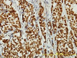 hCAP-D3 antibody (ab58058) used in immunohistochemistry at 2ug/ml on formalin fixed and paraffin embedded human breast cancer tissue.