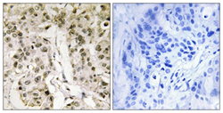 ab110896 at 1/50 dilution staining HCF-1 / Host Cell Factor C1 in paraffin-embedded Human Breast carcinoma tissue by Immunohistochemistry. The image on the right is treated with the synthesized peptide.