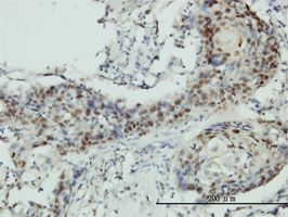 RNMT antibody (ab57893) used in immunohistochemistry at 3ug/ml on formalin fixed and paraffin embedded human squamous cell carcinoma tissue.