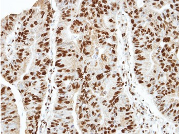 Immunohistochemical analysis of paraffin embedded AIHC xenograft, labelling HDAC1 with ab137652 at 1/100 dilution.