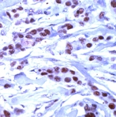ab15316 staining HDAC1 in breast carcinoma by Immunohistochemistry (FFPE-sections).