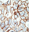 Immunohistochemical analysis of paraffin embedded Human breast carcinoma tissue labelling HDAC11 with ab135492 antibody at a dilution of 1/50, which was peroxidase-conjugated to the secondary antibody, followed by DAB staining.
