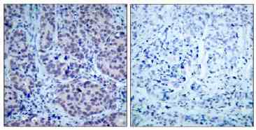 Ab39669 staining human HDAC2 in human breast carcinoma by immunohistochemistry using paraffin embedded tissue. Left: Untreated. Right: Treated with synthesized peptide.