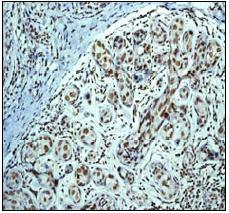 ab76295, at a 1/100-1/250 dilution, staining human HDAC3 in breast carcinoma, by Immunohistochemistry, Formalin/PFA-fixed paraffin-embedded tissue.