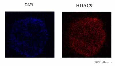 ab18970 staining human breast cancer cells by ICC/IF.  Cells were PFA fixed and permeabilized in 0.5% Triton X-100 prior to blocking in 5% BSA for 1 hour and 25°C.  The primary antibody was diluted 1/50 and incubated with the sample for 3 hours at 25°C.  A Texas Red® conjugated donkey anti-rabbit antibody was used as the secondary.See Abreview