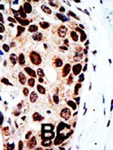 Formalin-fixed, paraffin-embedded human breast carcinoma tissue reacted with ab70954 at a 1:50 dilution. A peroxidase-conjugated secondary antibody was then used, followed by DAB staining.