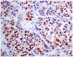 ab128921, at a 1/100 dilution, staining HDGF in paraffin embedded Human hepatocellular carcinoma tissue by Immunohistochemistry.