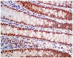 ab128921, at a 1/100 dilution, staining HDGF in paraffin embedded Human colon tissue by Immunohistochemistry.