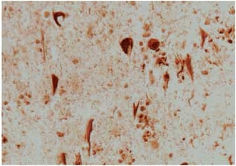 Alzheimer diseased section stained with ab13243.