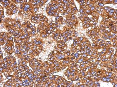 Immunohistochemical analysis of paraffin-embedded Human hepatoma tissue, labeling Heparin Cofactor II with ab153929 at 1/500 dilution.