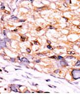 ab76099, at 1/50 dilution, staining CTDSP1 in formalin-fixed, paraffin-embedded human hepatocarcinoma tissue by Immunohistochemistry, followed by a peroxidase conjugated secondary antibody and DAB staining.