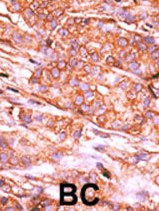 Ab60235 (1/50-1/100) staining human CTDSP2 in human breast carcinoma tissue by immunohistochemistry using formalin fixed, paraffin embedded tissue. Formalin-fixed and paraffin-embedded human cancer tissue reacted with the primary antibody, which was peroxidase-conjugated to the secondary antibody, followed by AEC staining. BC = breast carcinoma tissue.