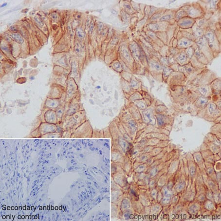 Immunohistochemical analysis of paraffin-embedded Human colon cancer tissue labeling CTNNA3 with ab184916 at 1/2000 dilution, followed by Goat Anti-Rabbit IgG H&L (HRP) (ab97051) secondary antibody at 1/500 dilution. Cytoplasmic and membrane staining on tumor cells of Human colonic adenocarcinoma is observed. Counter stained with Hematoxylin.Secondary antibody only control: Used PBS instead of primary antibody, secondary antibody is Goat Anti-Rabbit IgG H&L (HRP) (ab97051) at 1/500 dilution.