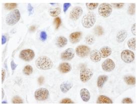 ab 84487 at 1/250 dilution staining formalin-fixed, paraffin-embedded section of human breast carcinoma by immunohistochemistry. Detection: DAB staining